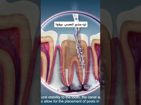 فيديو: هل الأسنان المكسورة تؤلم؟