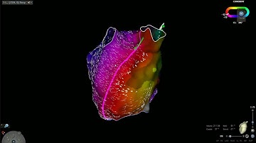 Left Atrial Tachycardia. One shot, one kill (I)