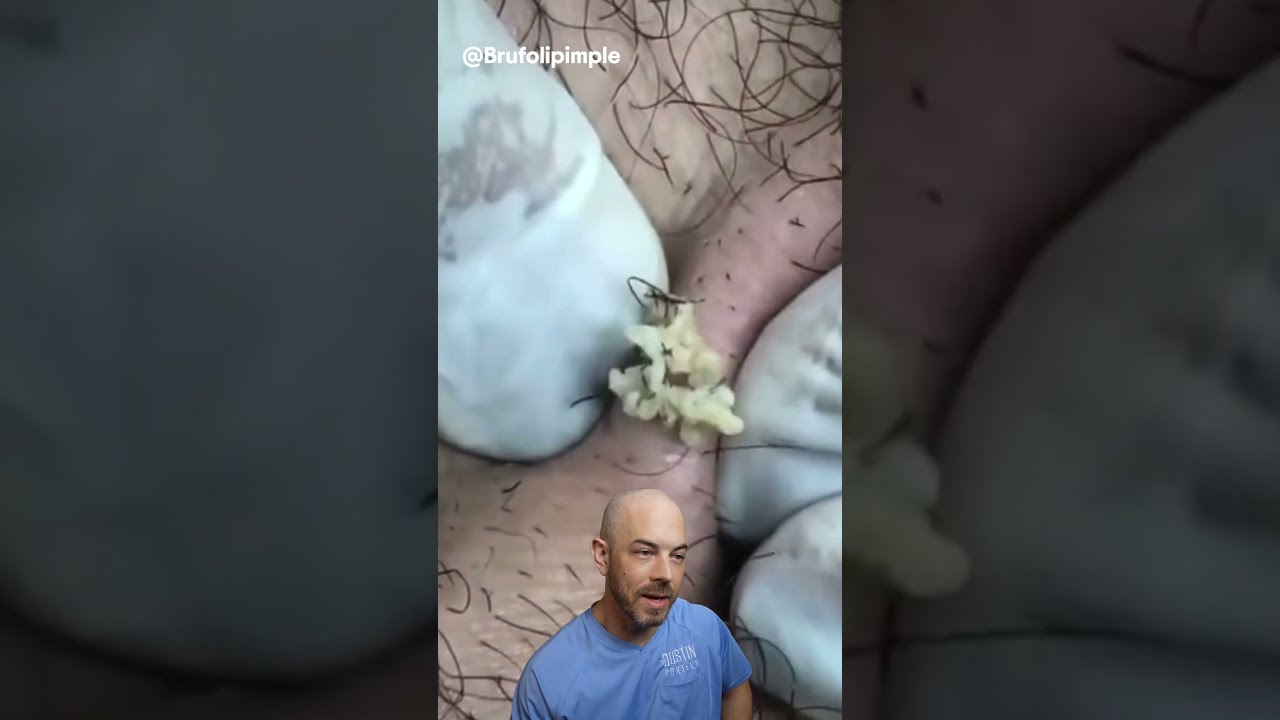 You Aren T Ready For This Cyst And Ingrown Hair Combo Credit Brufoilpimple Doctor Satisfying