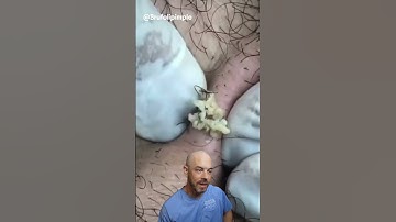 You aren’t ready for this cyst and ingrown hair combo👊💥 (credit: @brufoilpimple) #doctor#satisfying