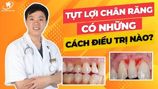 Tụt lợi chân răng, có những cách điều trị nào?
