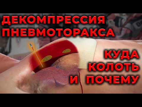 Пневмоторакс. Куда, как и почему вводить декомпрессионную иглу. #ПроСМП