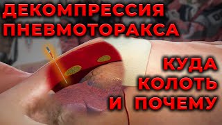 Пневмоторакс. Куда, как и почему вводить декомпрессионную иглу. #ПроСМП