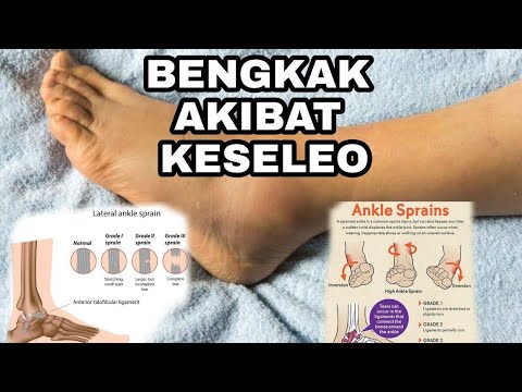 Video: Ligamen Terkilir: Penyebab, Gejala Dan Pengobatan