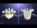 Vertebral crack osteotomy using drilling technique