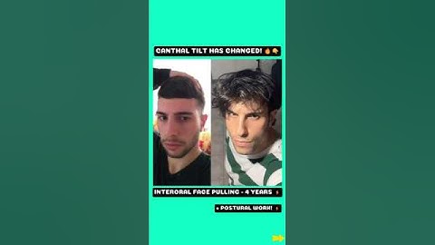 CANTHAL TILT: Biomechanics Behind! 🔥 Before & After 🔥 Interoral Face Pulling 🌎 #thumbpulling