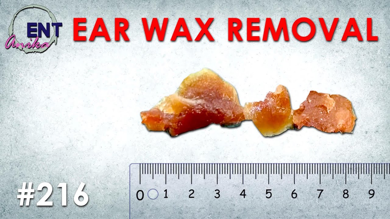 AnikaENT Ear Cleaning, Amazingly Huge Ear Wax Removal Compilation