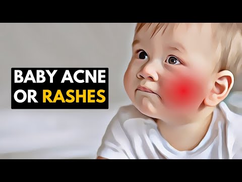 Gentle Care for Little Faces: Managing Baby Acne and Rashes