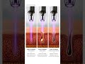 Why Cold Plasma Is Trending in Aesthetics ✨