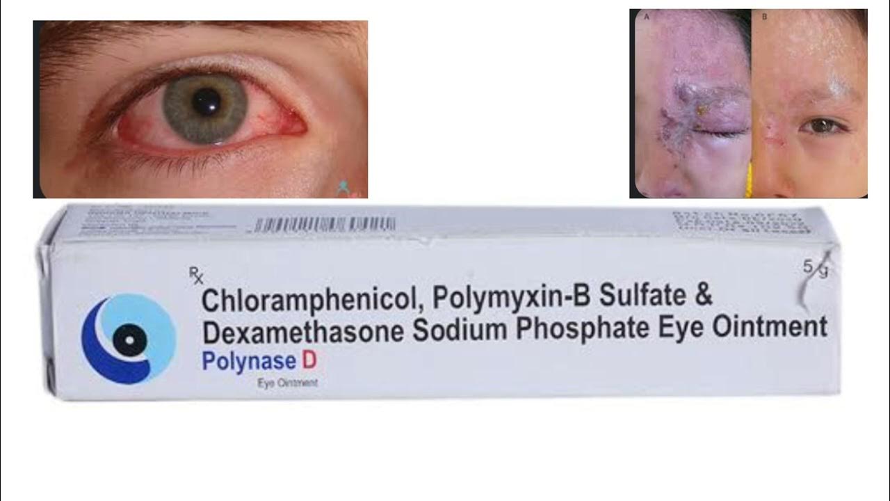 Dexamethasone eye ointment Polynase D uses, Optometry solution