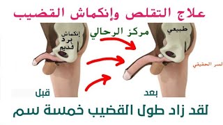 وداعا لتقلص وإنكماش القضيب الحل الأمثل للحصول على حجم مثالي طبيعي 0660294230