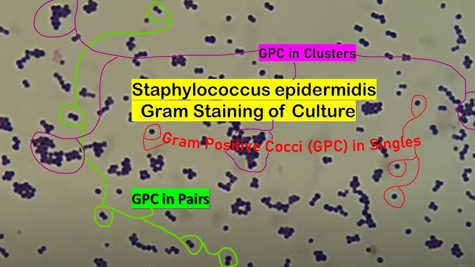 Staphylococcus aureus light microscopy. Morphology of Staphylococcus aureus  under the microscope. Micrograph of S.aureus, Gram stain. Gram-stained  smear from culture.