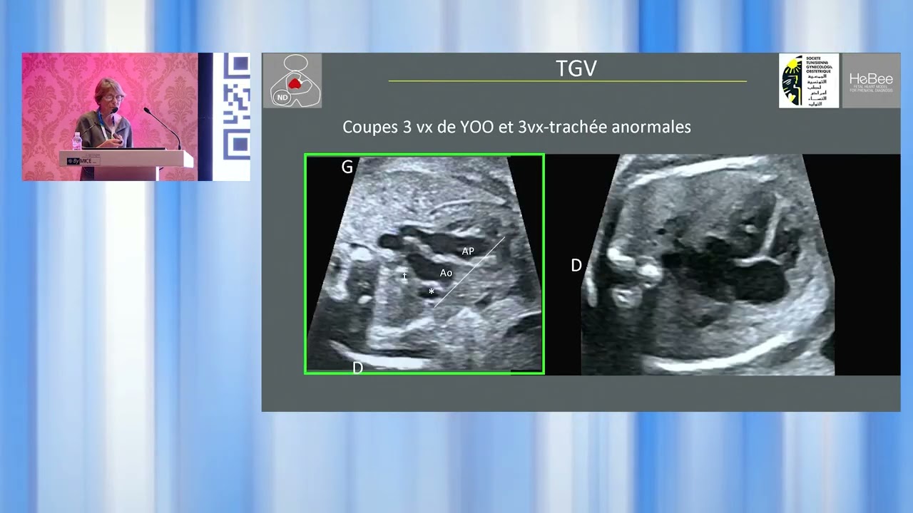 Les Journées d'échographie Septembre 2024:Les cardiopathies congénitales à ne pas rater : Dr N.David