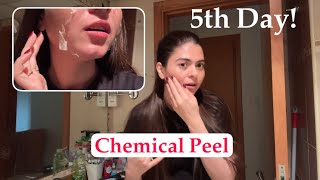 Chemical Peel 5th Day Condition | Skin Routine | Shilpa Chaudhary