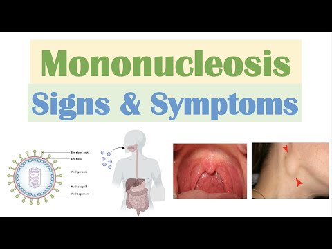 Infectious Mononucleosis Signs x Symptoms