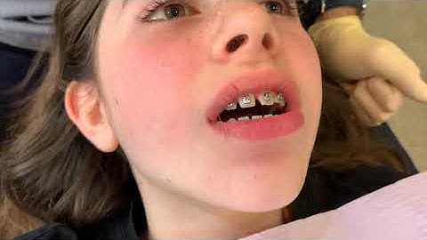 Triamond & Wedgewise - Bracket placement at bonding