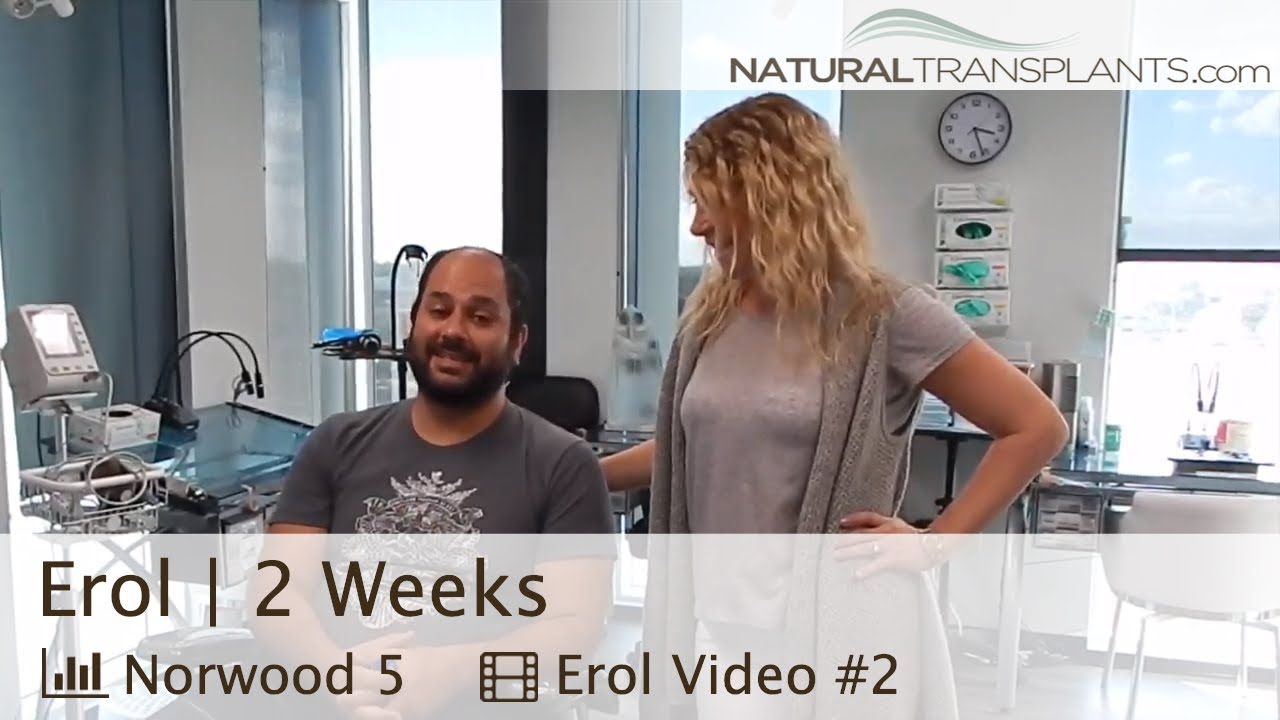 fue hair transplant month by month Receding Hairline Transplant | 2 Week Update on Hairline Transplant (Erol)