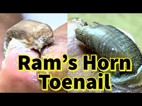 ram's-horn-toenail:-severe-fungal-toenail