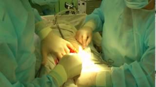 Кесарево сечение! Двойняшки! Cesarean section.(Врач: Захарян Армен Иванович., 2013-10-16T15:34:44.000Z)