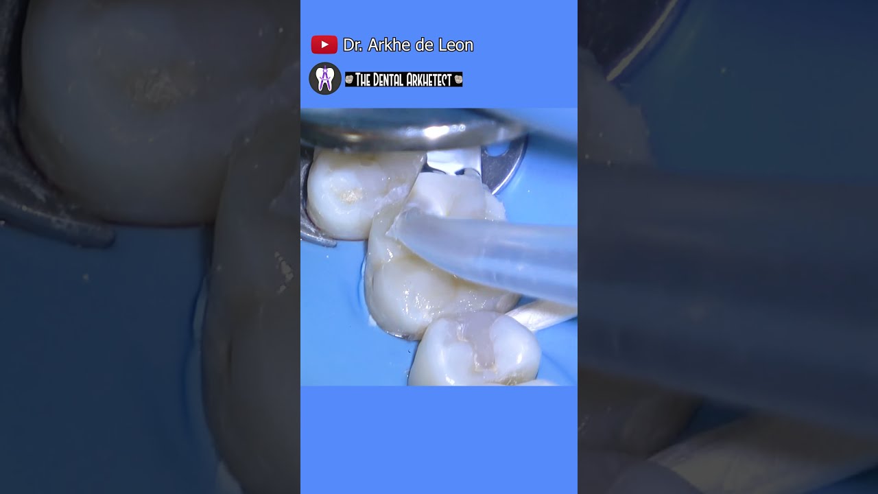 AMAZING Restoration Of A Dental Dentist Dentistry Teethhealth Toothfilling