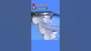 AMAZING Restoration of A Restoration #dental #dentist #dentistry #teethhealth #toothfilling