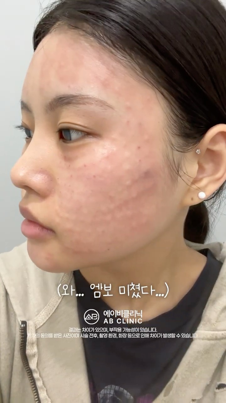 리쥬란 시술 과정