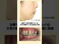 口ゴボ、出っ歯の歯列矯正 |#歯科矯正 #braces#矯正歯科