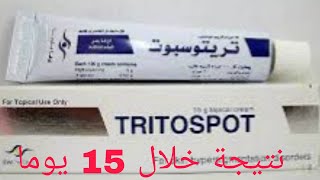 Tritospot الكريم السحري لعلاج التصبغات الجلدية