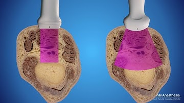 iPACK Block Interspace Between the Popliteal Artery and Capsule of the Knee