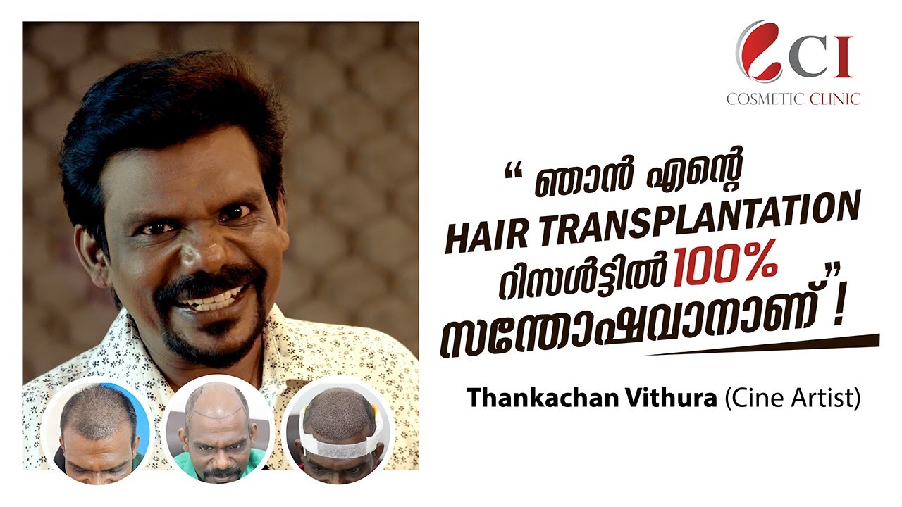 ഞാൻ എൻ്റെ Hair Transplantation റിസൾട്ടിൽ 100% സന്തോഷവാനാണ്! | Thankachan Vithura (Cine Artist)