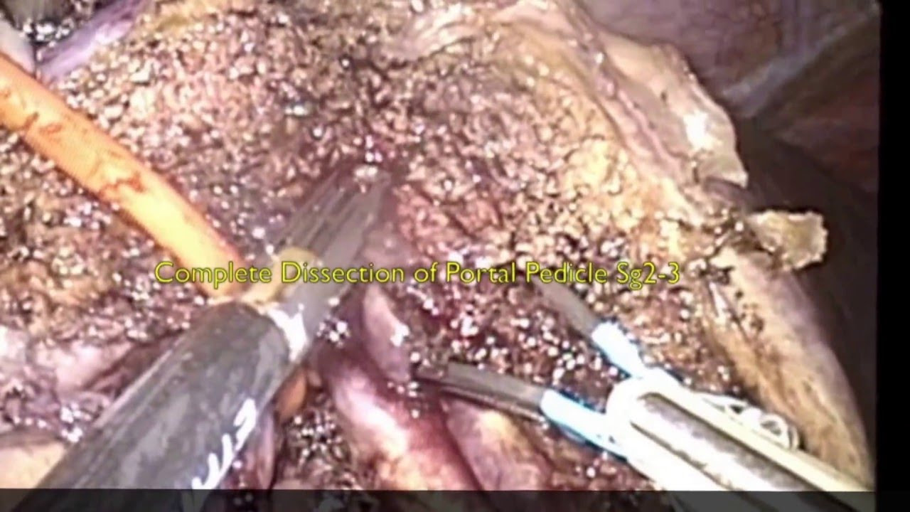 Laparoscopic Left Lateral Sectionectomy for Intrahepatic Cholangiocarcinoma