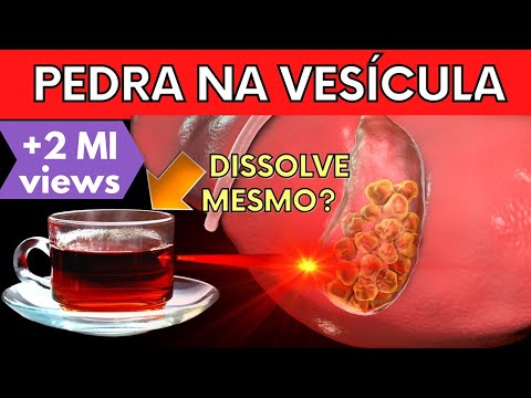 Vídeo: 3 maneiras de passar cálculos biliares naturalmente