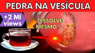 SINTOMAS DE PEDRA NA VESÍCULA | Tem jeito de eliminar cálculos biliares NATURALMENTE (colelitíase)