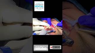 “Flapless Dental Implant with Immediate Loading | Upper Premolar Procedure | Chandigarh”