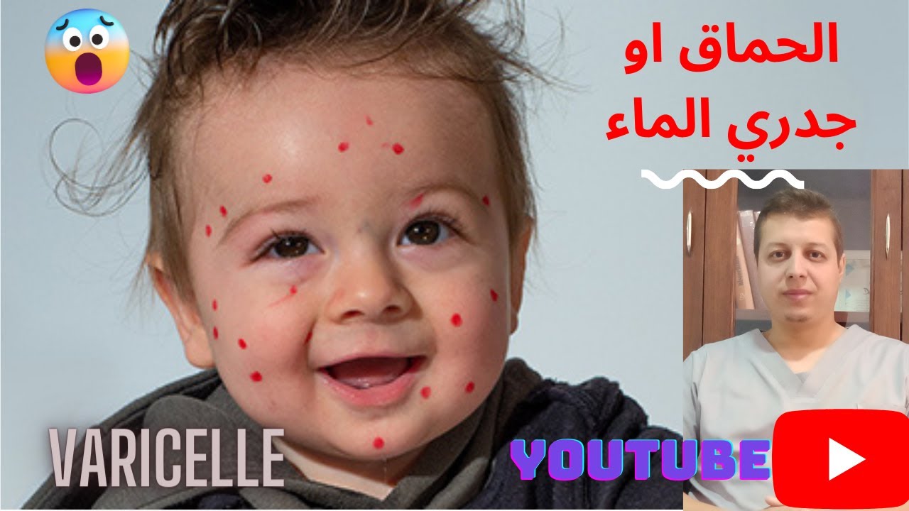 Varicelle chez les enfants : tout ce que vous devez savoir . الجدري عند الأطفال: ما عليك معرفته