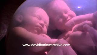 Monoamniotic-Monochorionic Twins - 36 weeks