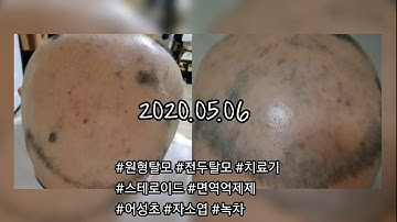 남자 간호사 전두성 원형탈모 치료기 - 자소엽, 어성초, 녹차 | alopecia areata