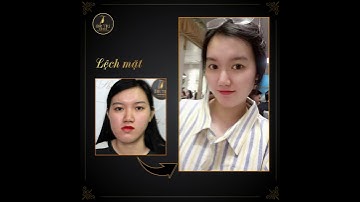 Trần Thị Ánh Mai Sau Khi Được Chỉnh Mặt Lệch Bởi Dr Trí | Phẫu Thuật Thẩm Mỹ Tiến Sĩ Trí