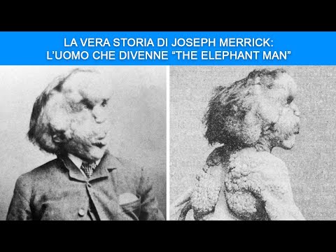 La Vera Storia di Joseph Merrick: l’Uomo che divenne “The Elephant Man”