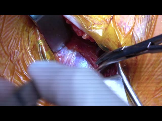 Obstructive sleep apnea surgery: inspire therapy surgical implant class=