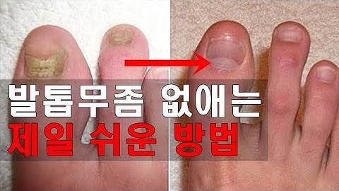 발톱무좀 없애는 방법