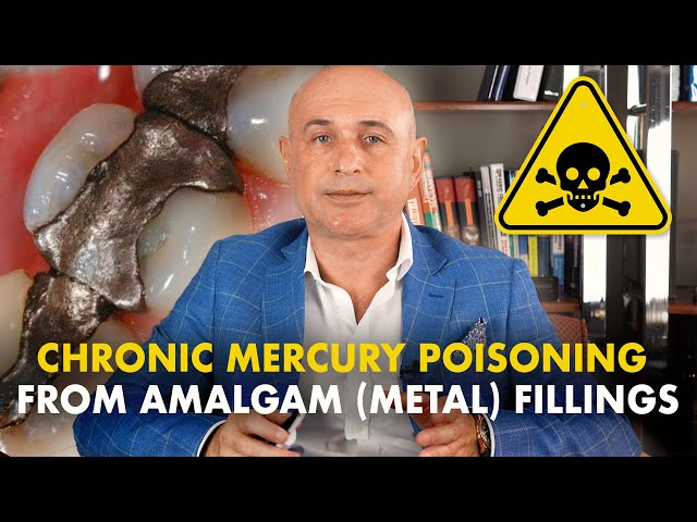 Amalgam (metal) fillings: Common symptoms of chronic mercury poisoning class=