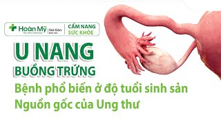 U nang buồng trứng: Dấu hiệu, Các giai đoạn, Ảnh hưởng mang thai và Thời điểm cần mổ | Khoa sản phụ