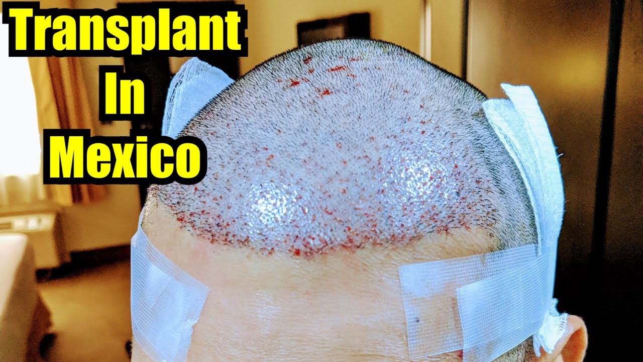 2nd Mexican Hair Transplant FUE-Hair Medical Restoration Tijuana - YouTube