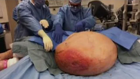 Doctors stunned by 140lb tumor growing inside PA woman - DayDayNews