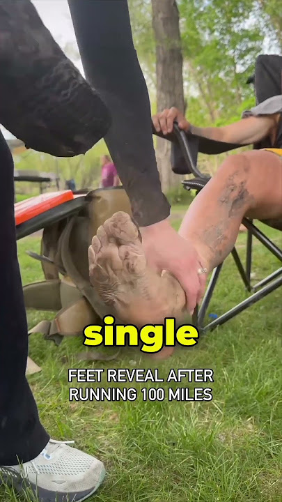 Feet After a 100 Mile Marathon (@BrockCovington)