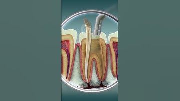 Root Canal Treatment | Curveia Dental I RCT