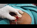 How to excise lipoma by dr anuj pall  eilams masterclass