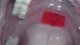 Swallowing Gummies with an Endoscope View