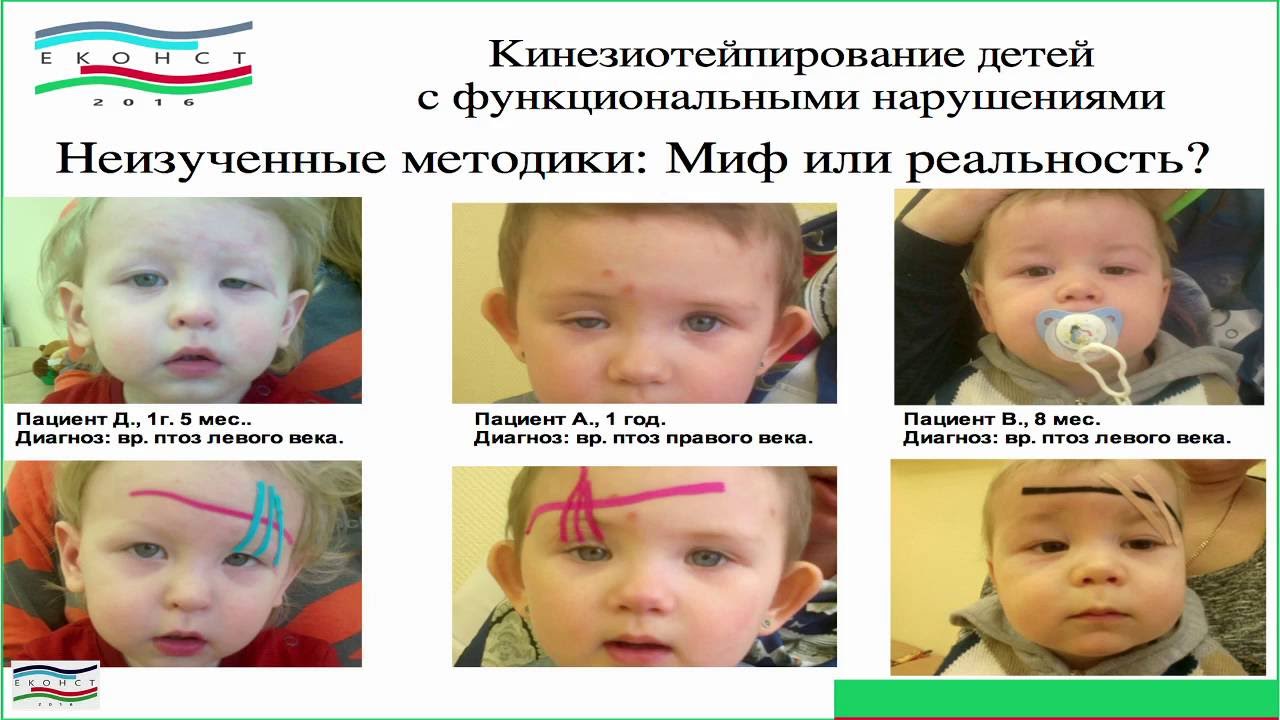 Хамидулина О. Н. Медицинское кинезиотейпирование детей часть 1 - YouTube